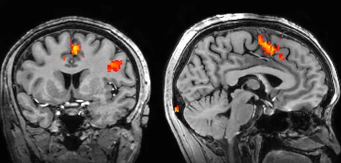 An example fMRI showing, with BOLD contrast visible in the reddish regions