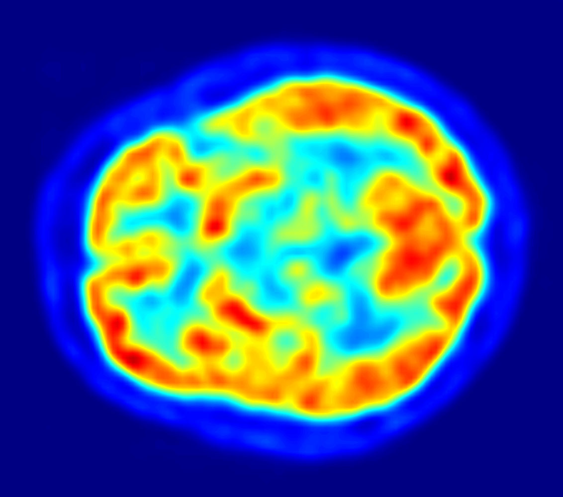 PET scan